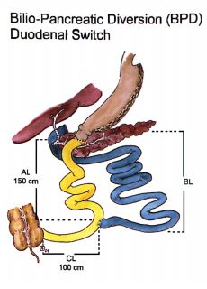  - Duodenal Switch.jpg-for-web-normal
